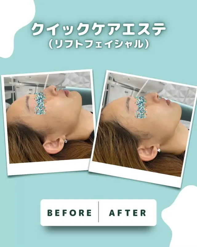 即効性を求めるなら【クイックケアエステ(リフトフェイシャル)...